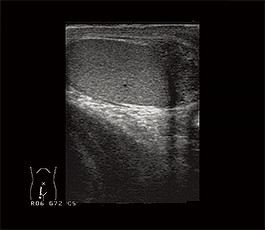 精巣 捻転 エコー