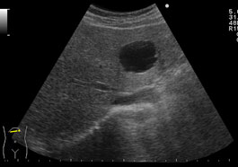 嚢胞 肝 巨大肝嚢胞の腹腔鏡下開窓術