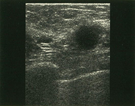 Fibromatosis