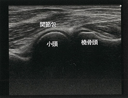 伸展位長軸像：右上腕骨小頭と橈骨頭像（成人）