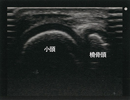 最大屈曲位短軸像：右上腕骨小頭と肘頭像（小児）