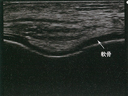 大腿骨関節軟骨短軸像：成人右膝