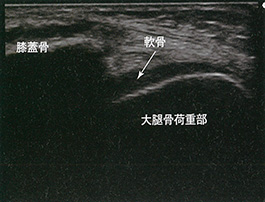 大腿骨関節軟骨荷重部短軸像：成人右膝