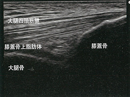 膝蓋骨近位部の長軸像：軽度屈曲位