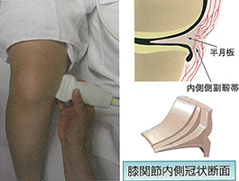 膝内側側副靭帯と半月板観察へのアプローチ：軽度屈曲位