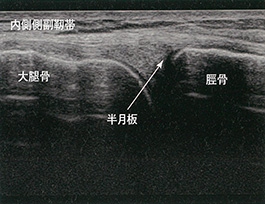 膝内側側副靭帯と半月板の長軸像：軽度屈曲位