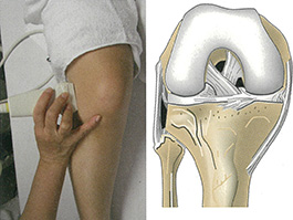 膝外側側副靭帯と半月板へのアプローチ：軽度屈曲位