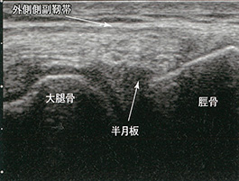 膝外側側副靭帯と半月板の長軸像：軽度屈曲位
