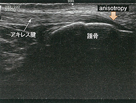 膝蓋骨近位部の長軸像：軽度屈曲位