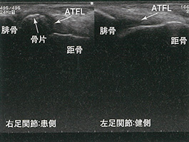 前距腓靭帯（ATFL）損傷像：成人