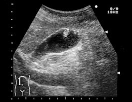 コレステロール検査とは何ですか?