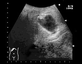 胆嚢超音波検査の準備はどのようにすればよいですか?