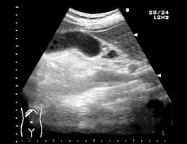 胆嚢腺筋腫症の原因は何ですか?誰がリスクにさらされていますか?