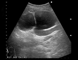 馬蹄形腎臓の症状