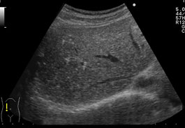 過誤腫が増殖する原因は何ですか?