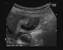 胆嚢炎はどのように治療されますか?