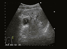 膵嚢胞とは何ですか?