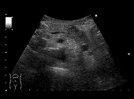 膵嚢胞を治療または予防するにはどうすればよいですか?