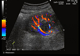 腎臓がんはどのように広がるのか